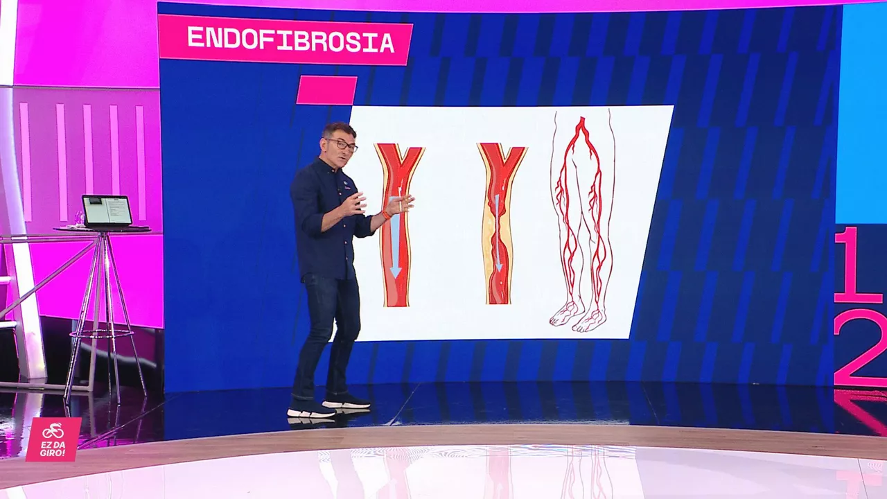 Endofibrosia - Xabier Usabiaga (Ez da Giro)